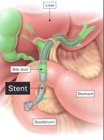 CBD Stenting